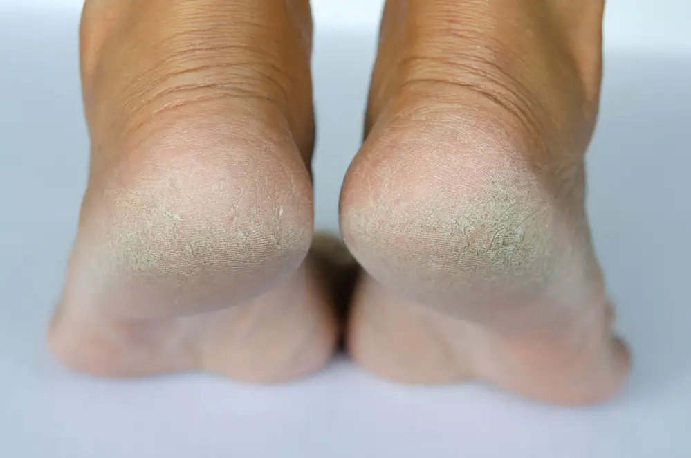 7 Home Remedies for Cracked Heels