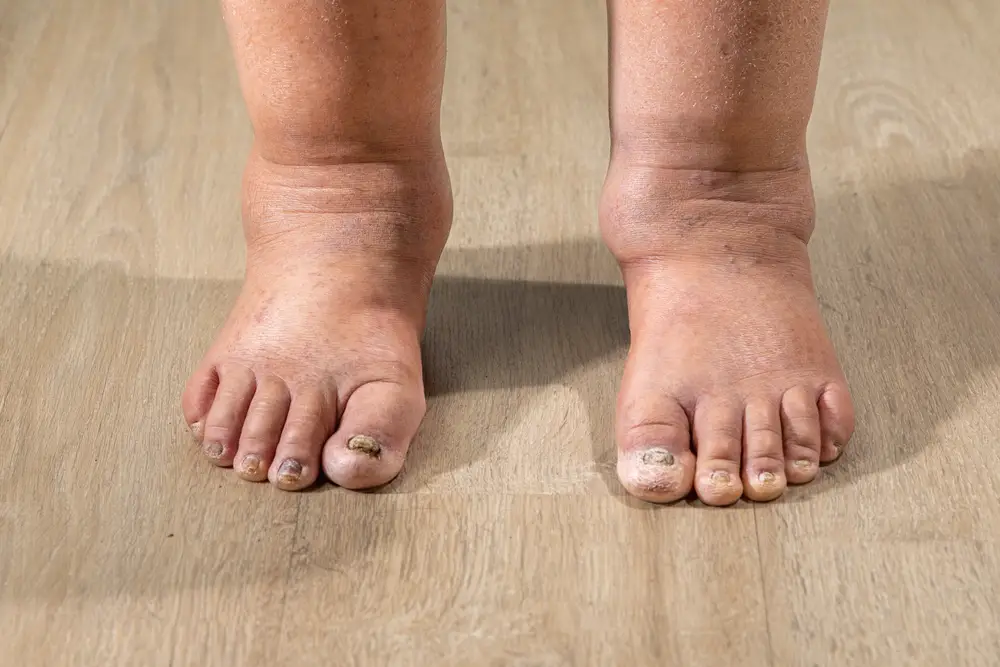 How To Stop Your Feet Swelling In Hot Weather
