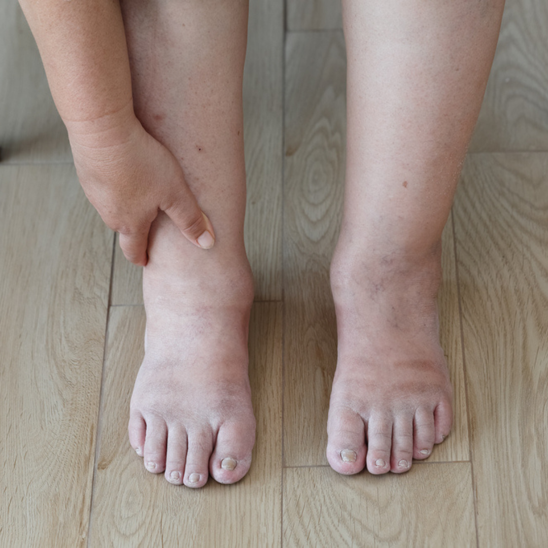 10 Home Remedies For Swollen Feet